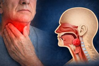 444. Laryngeal Cancer