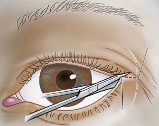 423. Ocular Trauma 1: Lid Lacerations and Orbital Compartment Syndrome