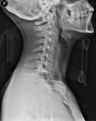 Podcast #191: Blunt Cervical Trauma