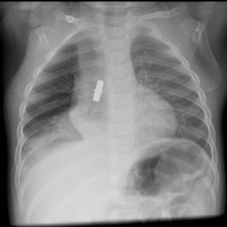 Tracheal Foreign Bodies