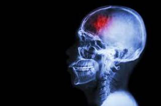 Podcast #333 - TBI Prognosticators