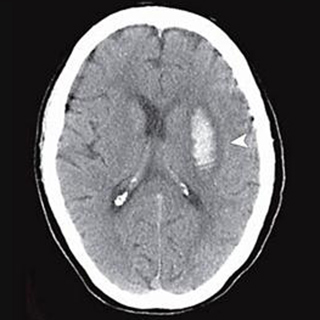 Thrombolytics and Endovascular Thrombectomy for Acute Ischemic Stroke