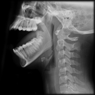 TMJ Dislocation