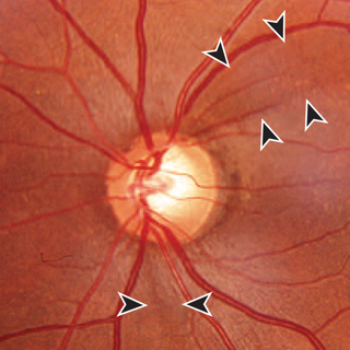 Rates of Visual Field Change in Individuals With and Without Glaucoma