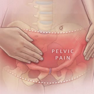 Diagnosis and Clinical Care of Women With Chronic Pelvic Pain