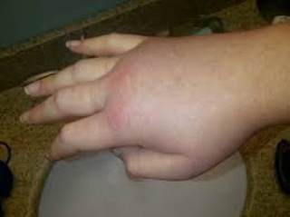 Podcast 651: Hereditary Angioedema