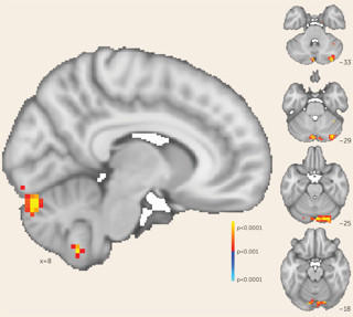 July 2019: Treating Negative Symptoms in Schizophrenia