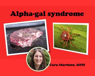 Alpha-gal syndrome, or Red Meat Allergy