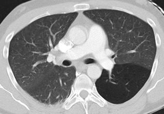 Podcast #271: Nexus Chest CT Scan Guidelines