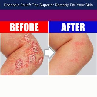 Psoriasis Relief: The Superior Remedy For Your Skin