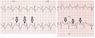 Podcast #282: EKG Changes in DKA