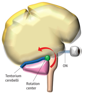 Modulation of Cerebro-ocular Hemodynamics and Pressures in a Model of Spaceflight-Associated Neuro-ocular Syndrome