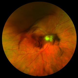Ophthalmic Screening Patterns in Youths With Diabetes