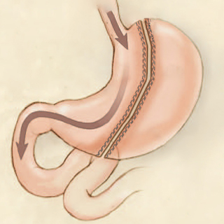 Update on Bariatric Surgery—2020