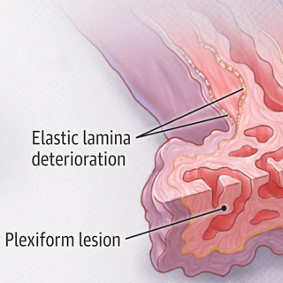 A Review of Pulmonary Arterial Hypertension