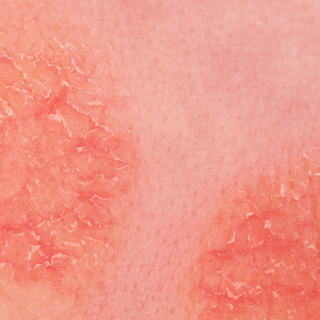 Treating Pediatric Eczema