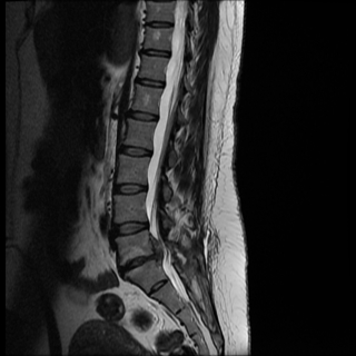Podcast # 360: Epidural Abscess Screening