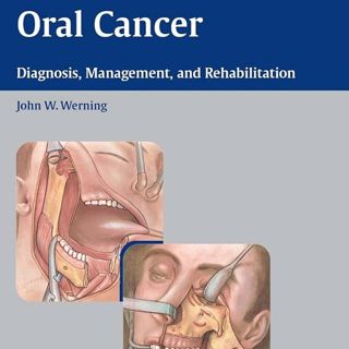 Oral Cancer: Diagnosis, Management, and Rehabilitation
