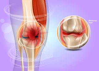349. Meniscal Tears