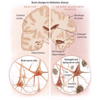 Alzheimer Disease Overview and the Possibility That It's Caused By Infections