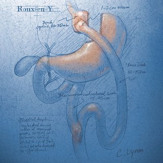 Bariatric Surgery and Cardiovascular Outcomes in Patients With Type 2 Diabetes and Obesity