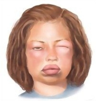 Podcast #276: Angioedema