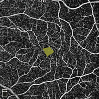 Association of Preclinical Alzheimer Disease With OCT Angiographic Findings