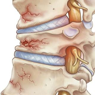 Calcium, Bone Density and Osteoporosis with Drs. Pelin Batur and Chad Deal