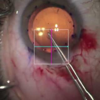 Cornea Preservation Time and Descemet Stripping Automated Endothelial Keratoplasty