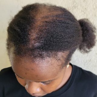 "I'm 23 and losing my hair"