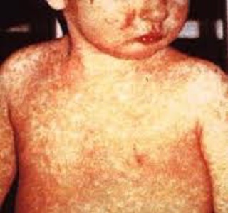 Podcast #443: Measles - a timely revisit