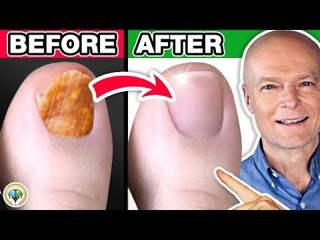 #1 Absolute Best Toenail Fungus Cure