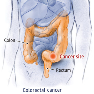 Q&A With Loren Laine, MD, on Highlights From Digestive Disease Week 2022