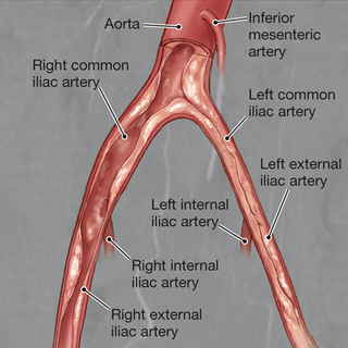 Lower Extremity Peripheral Artery Disease Without Chronic Limb-Threatening Ischemia