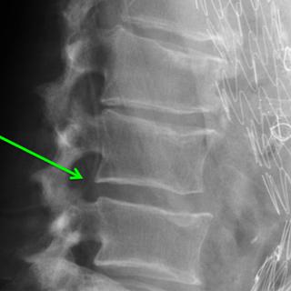 JAMA Performance Improvement: Retained Foreign Body From a Sheared Off Lumbar Drain