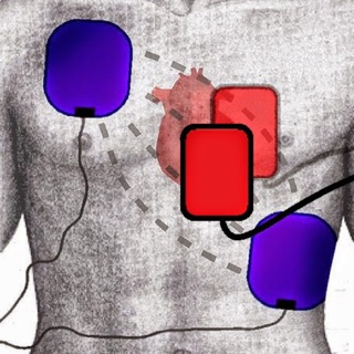 Defibrillation