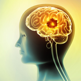 A Model for the Rarest Cancers: Choroid Plexus Carcinoma and the Li-Fraumeni Inheritable Cancer Syndrome.