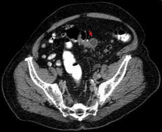 Podcast 727: Antibiotics for Diverticulitis