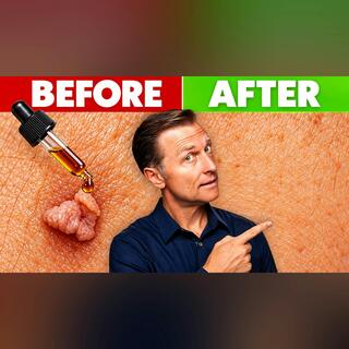 How to Get Rid of Skin Tags (and Stop Them For Good)